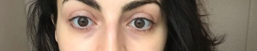 Customer photo review of Dark Circles Treatment