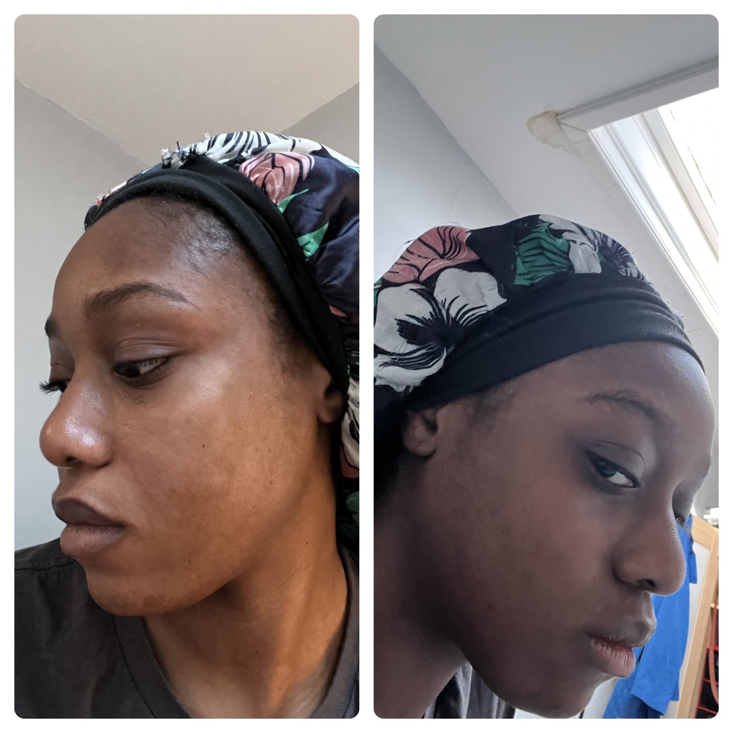 Customer photo review of Neoprosone Brightening Body Lotion 400ml