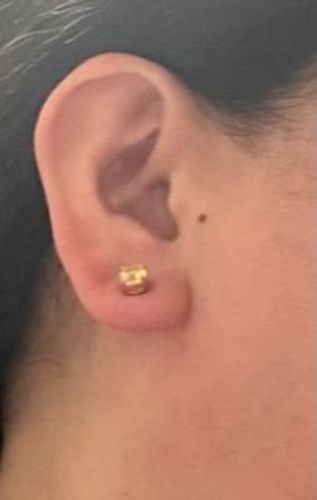 Customer photo review of SlimEdge™ DiamondCut LymphDetox Magnetherapy Earrings（Limited Time Discount 🔥 Last Day）