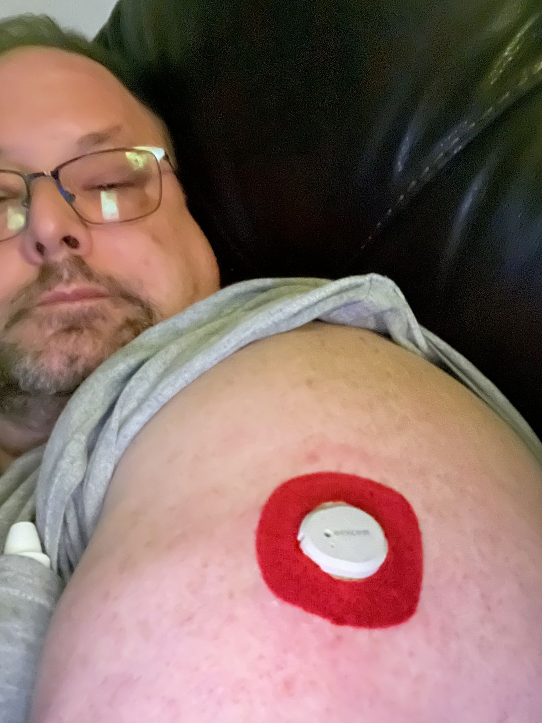 Customer photo review of Skin Grip Original - Dexcom G7 Adhesive Patches (With Hole)