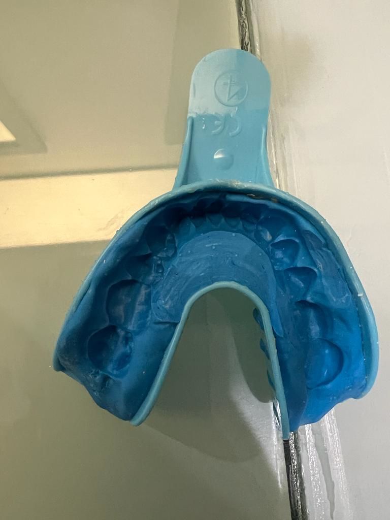Customer photo review of 3mm Ultra Hard Night Guard for Severe Teeth Grinding/Clenching- Maximum Protection while you Sleep