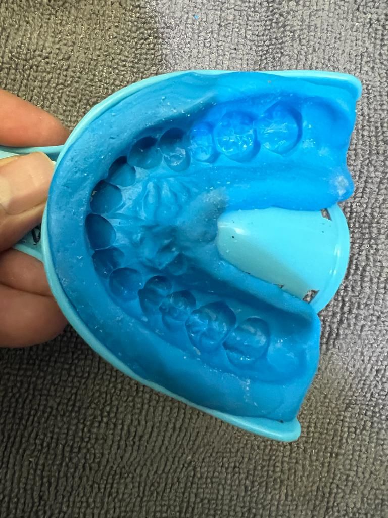 Customer photo review of 2mm Soft Night Guard for Light Teeth Grinding / Clenching - Comfortable, Custom-Fit Protection