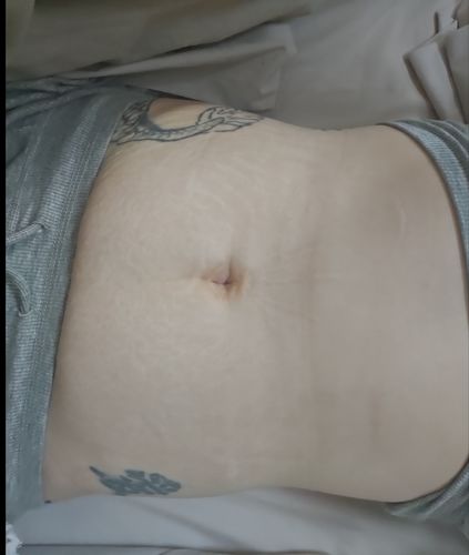 Customer photo review of Femvy Face and Body Skin Tightening Radio Frequency Device