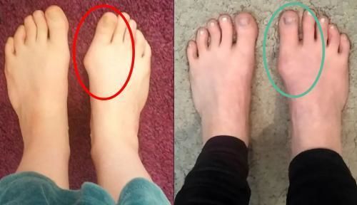 Customer photo review of Treatmedy™ Bunion Fix - Natural At-Home Bunion Relief