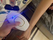Customer photo review of GLIMORA®  - IPL Haarentfernung