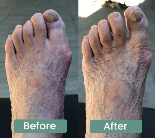 Customer photo review of Treatmedy™ Bunion Fix - Natural At-Home Bunion Relief
