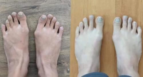 Customer photo review of Treatmedy™ Bunion Fix - Natural At-Home Bunion Relief