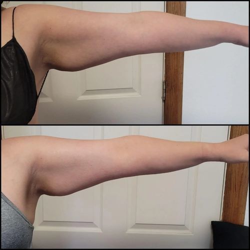 Customer photo review of 5 in 1 - Anti Cellulite-Massagegerät