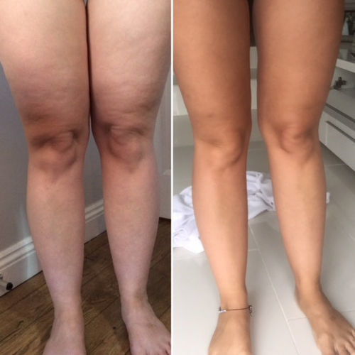 Customer photo review of 5 in 1 - Anti Cellulite-Massagegerät