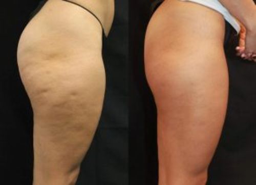 Customer photo review of 5 in 1 - Anti Cellulite-Massagegerät