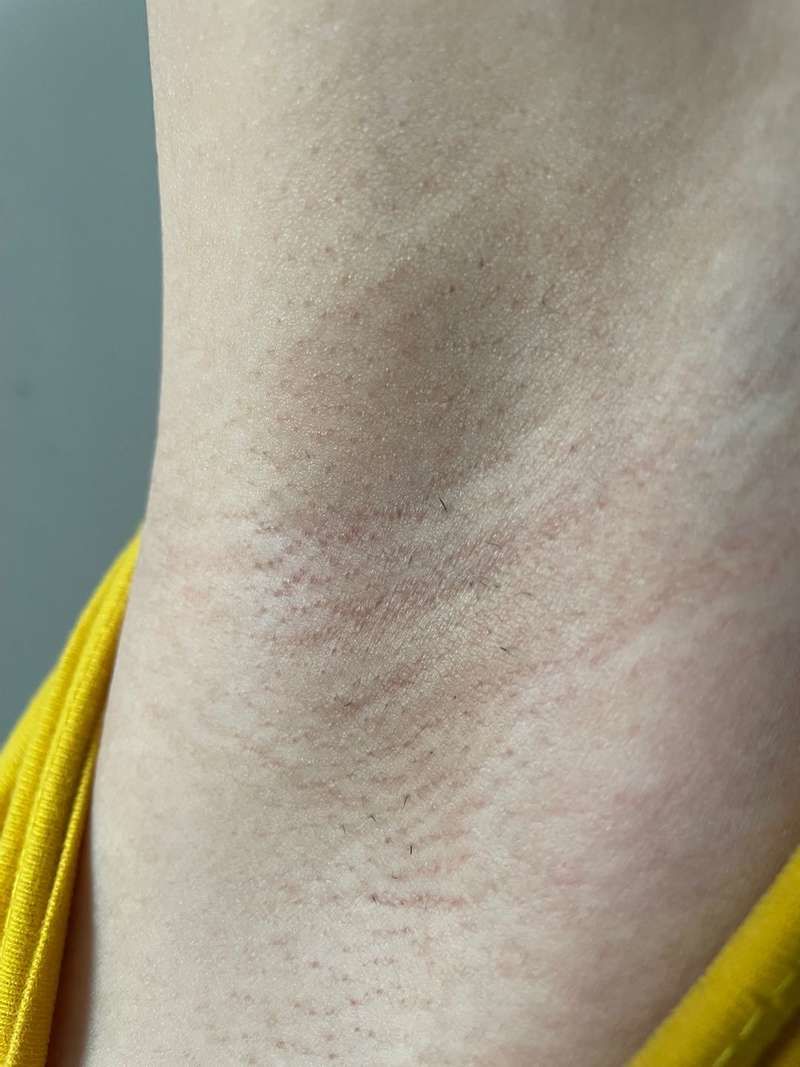 Customer photo review of IPL Pro - Permanent Hårfjerner