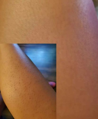 Customer photo review of IPL Pro - Permanent Hårfjerner