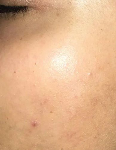 Customer photo review of IPL Pro - Permanent Hårfjerner