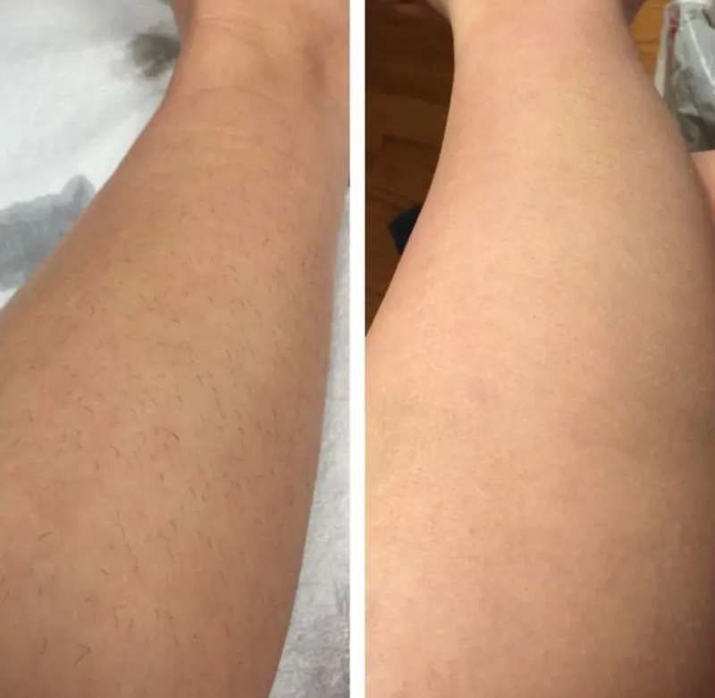 Customer photo review of IPL Pro - Permanent Hårfjerner