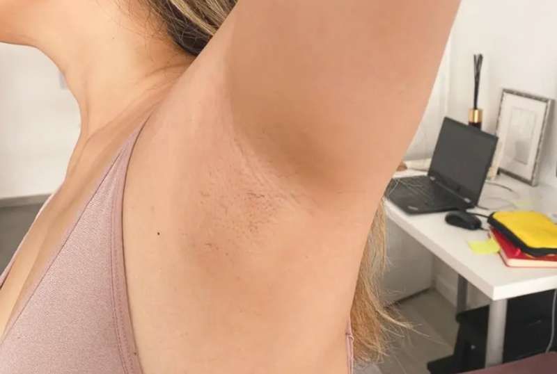Customer photo review of IPL Pro - Permanent Hårfjerner