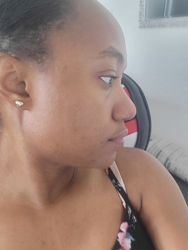 Customer photo review of FRESH FACE PACKAGE (Cleanser x Toner x Serum)