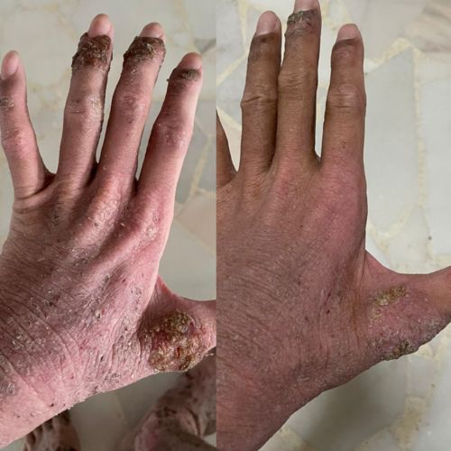 Customer photo review of Eczema Scratch Mitten