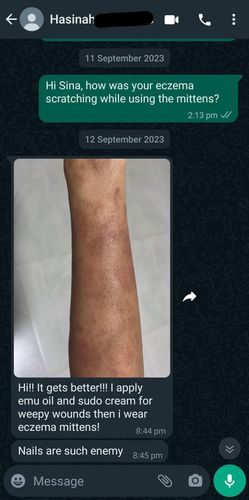 Customer photo review of Eczema Scratch Mitten