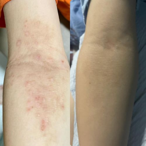 Customer photo review of Eczema Scratch Mitten