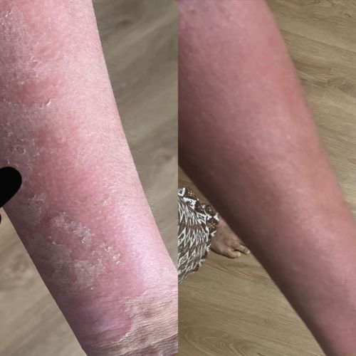 Customer photo review of Eczema Scratch Mitten