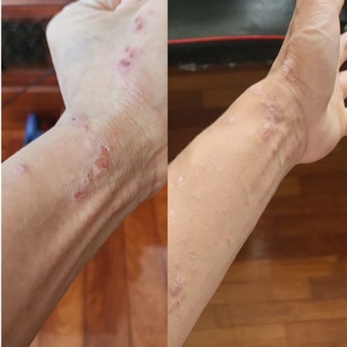 Customer photo review of Eczema Scratch Mitten