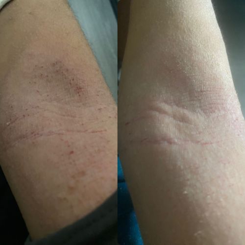 Customer photo review of Eczema Scratch Mitten