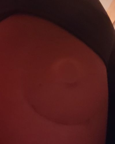 Customer photo review of Skin Grip Original - Freestyle Libre Adhesive Patches