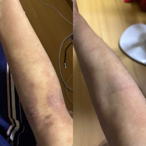 Customer photo review of Eczema Scratch Mitten