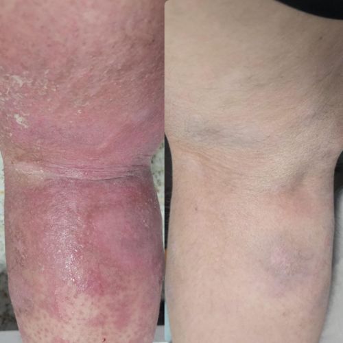 Customer photo review of Eczema Scratch Mitten