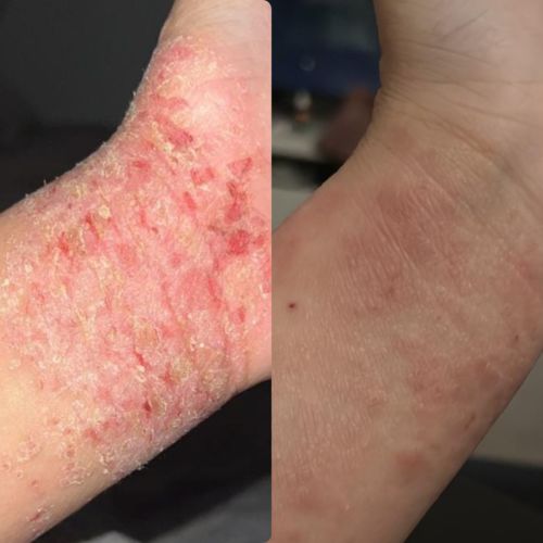 Customer photo review of Eczema Scratch Mitten