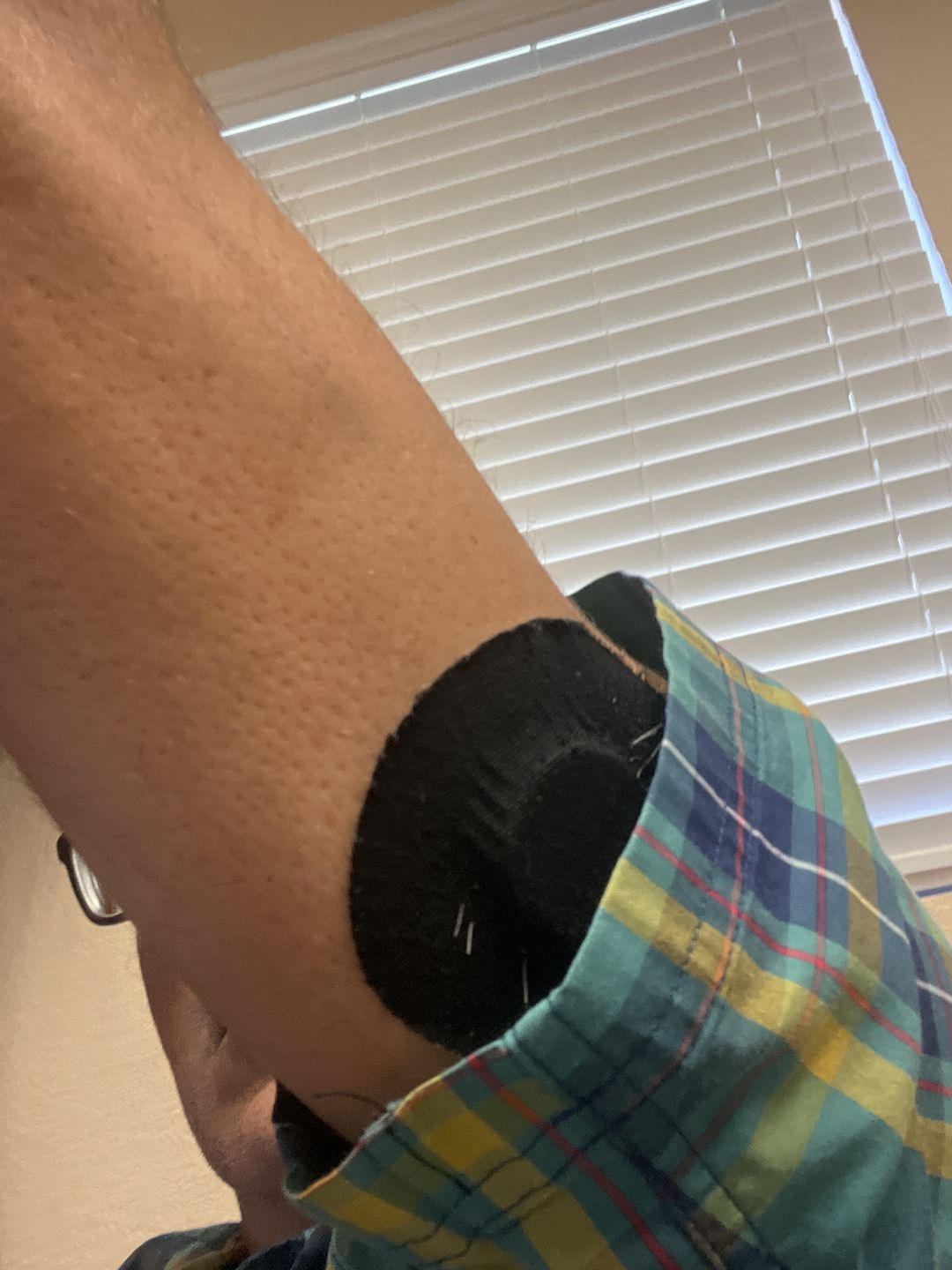 Customer photo review of Skin Grip Original - Freestyle Libre Adhesive Patches