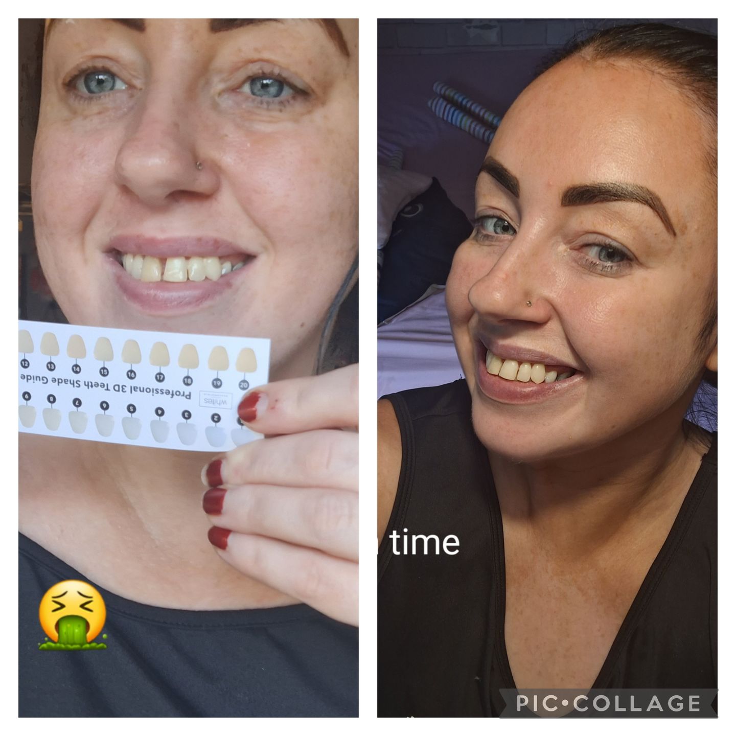 Customer photo review of Teeth Whitening Strips