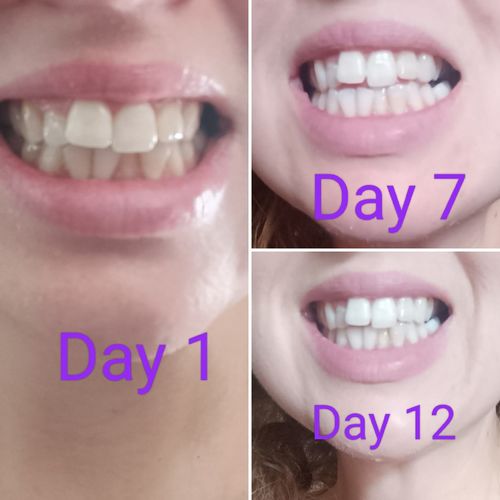 Customer photo review of Teeth Whitening Strips