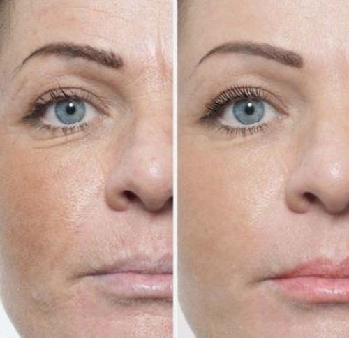 Customer photo review of Siero viso all' Acido Ialuronico