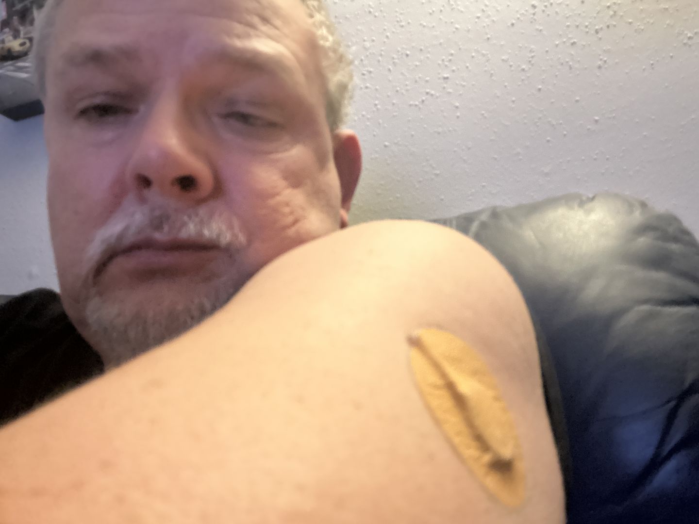 Customer photo review of Skin Grip MAX Freestyle Libre 3 Patches