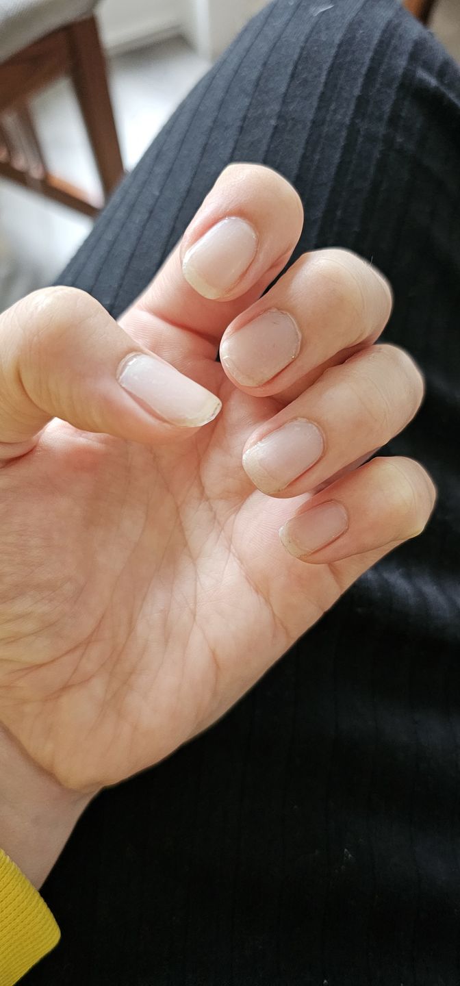 Customer photo review of Crystal Clear DIY Semicured Gel Nail Sticker Kit (STOP NAIL BITING & GROW BRITTLE NAILS)