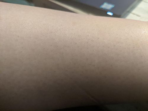 Customer photo review of Depiladora Premium IPL