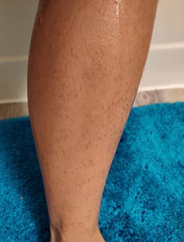 Customer photo review of Depiladora Premium IPL