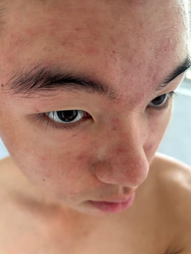 Customer photo review of LOVESKIN Kiri Aroha Facial Serum - Acne/ Combination Skin