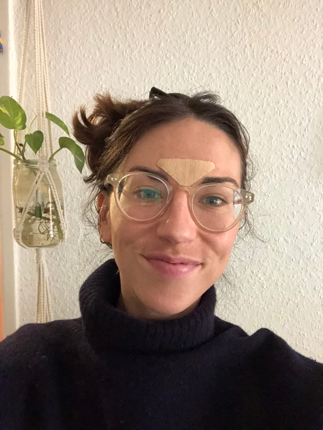 Customer photo review of Zornesfalten Patches mit Hyaluron