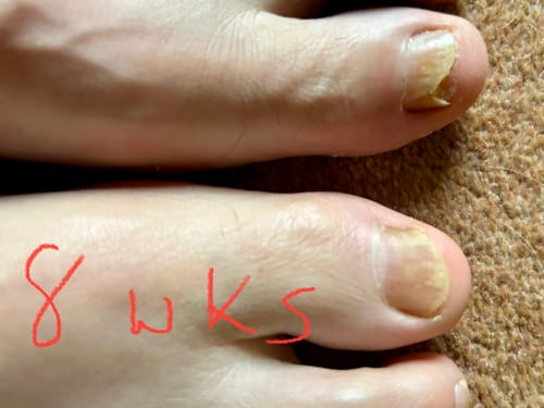 Customer photo review of Onychom - Antifungal Laser Device