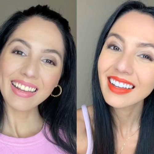 Customer photo review of Polar MD Teeth Whitening Kit