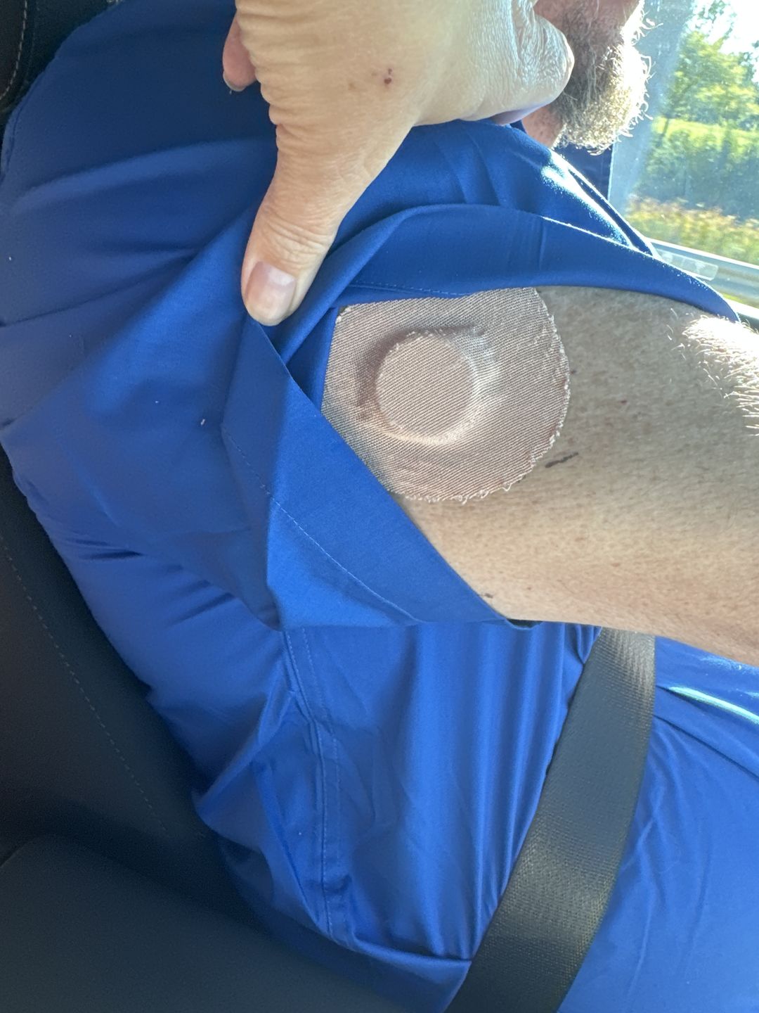 Customer photo review of Skin Grip Original - Freestyle Libre Adhesive Patches
