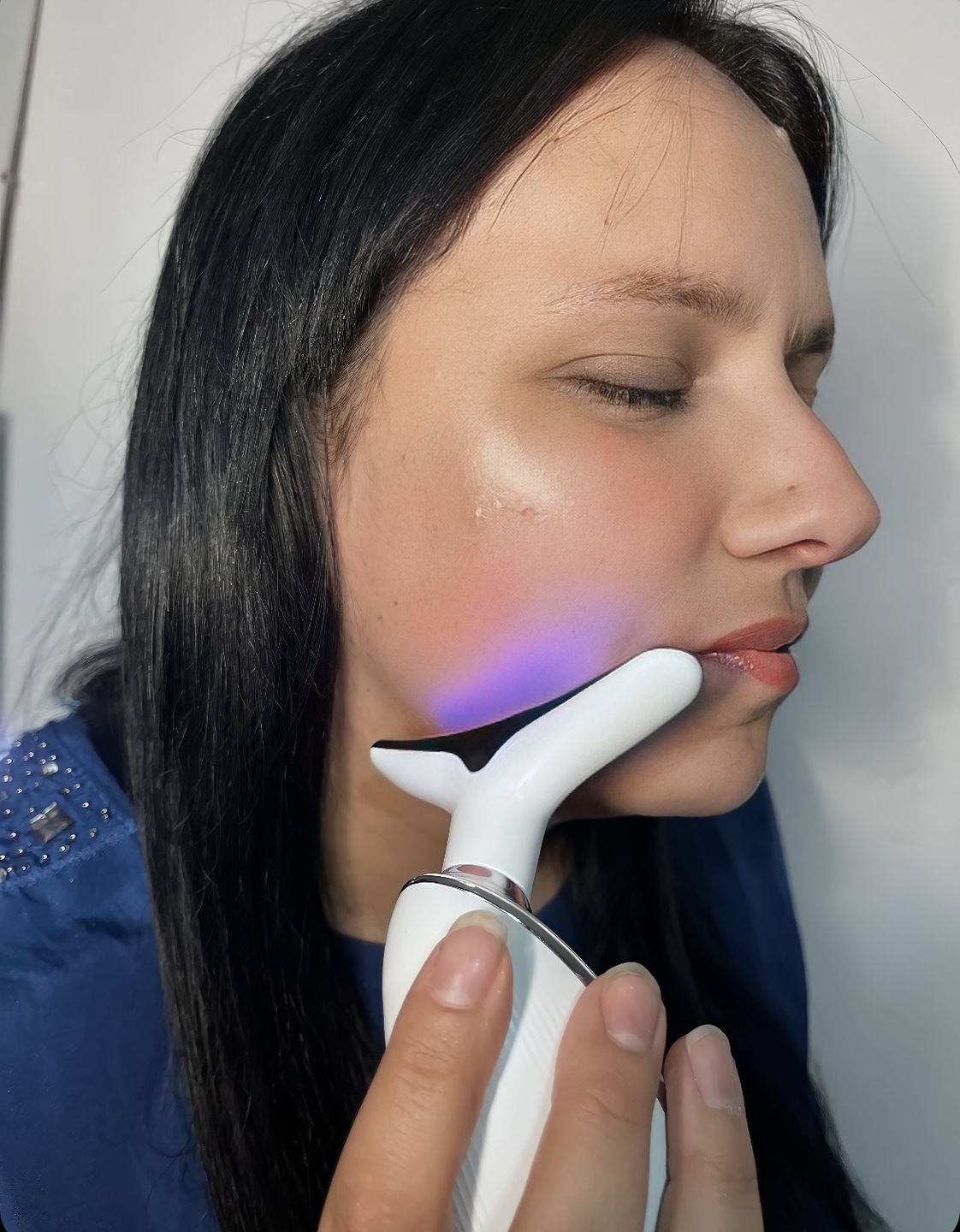 Customer photo review of Reductor de Arrugas Iluminex 3.0 Blumin