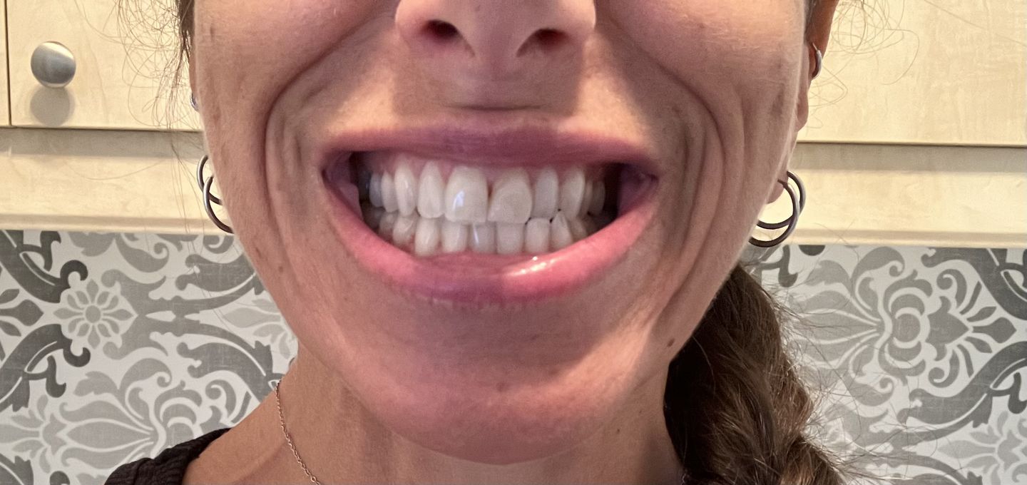 Customer photo review of Bandes Blanchissantes PAP (sans peroxyde)
