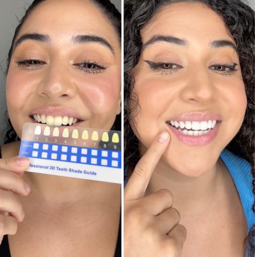 Customer photo review of Polar MD Teeth Whitening Kit