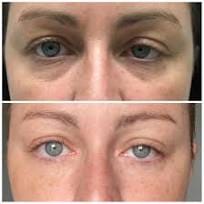 Customer photo review of Crème Anti Cernes Instantanée