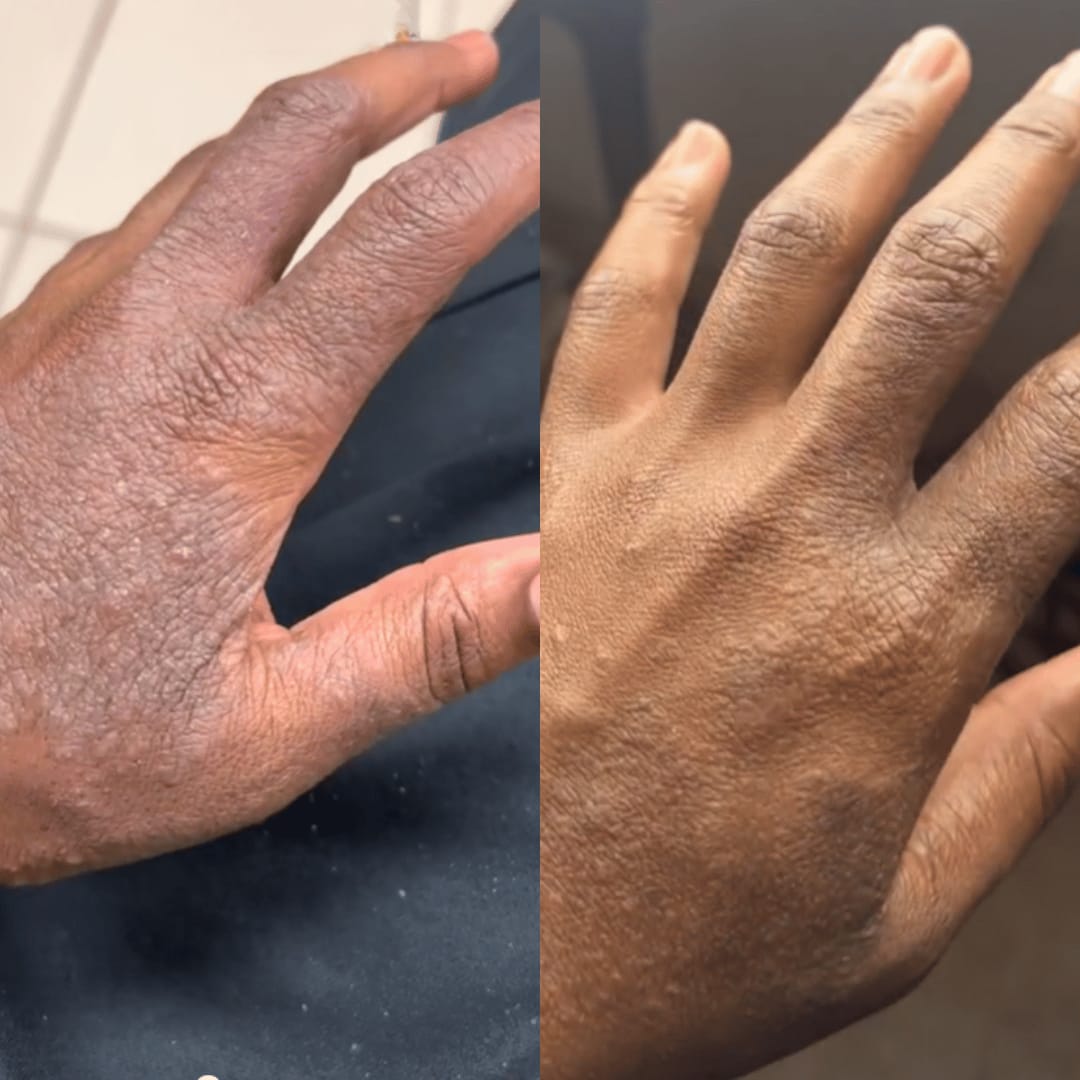 Customer photo review of HOCL Skin Healing Duo