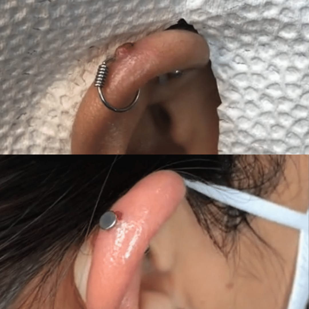 Customer photo review of Keloid Bump Shrinking Duo