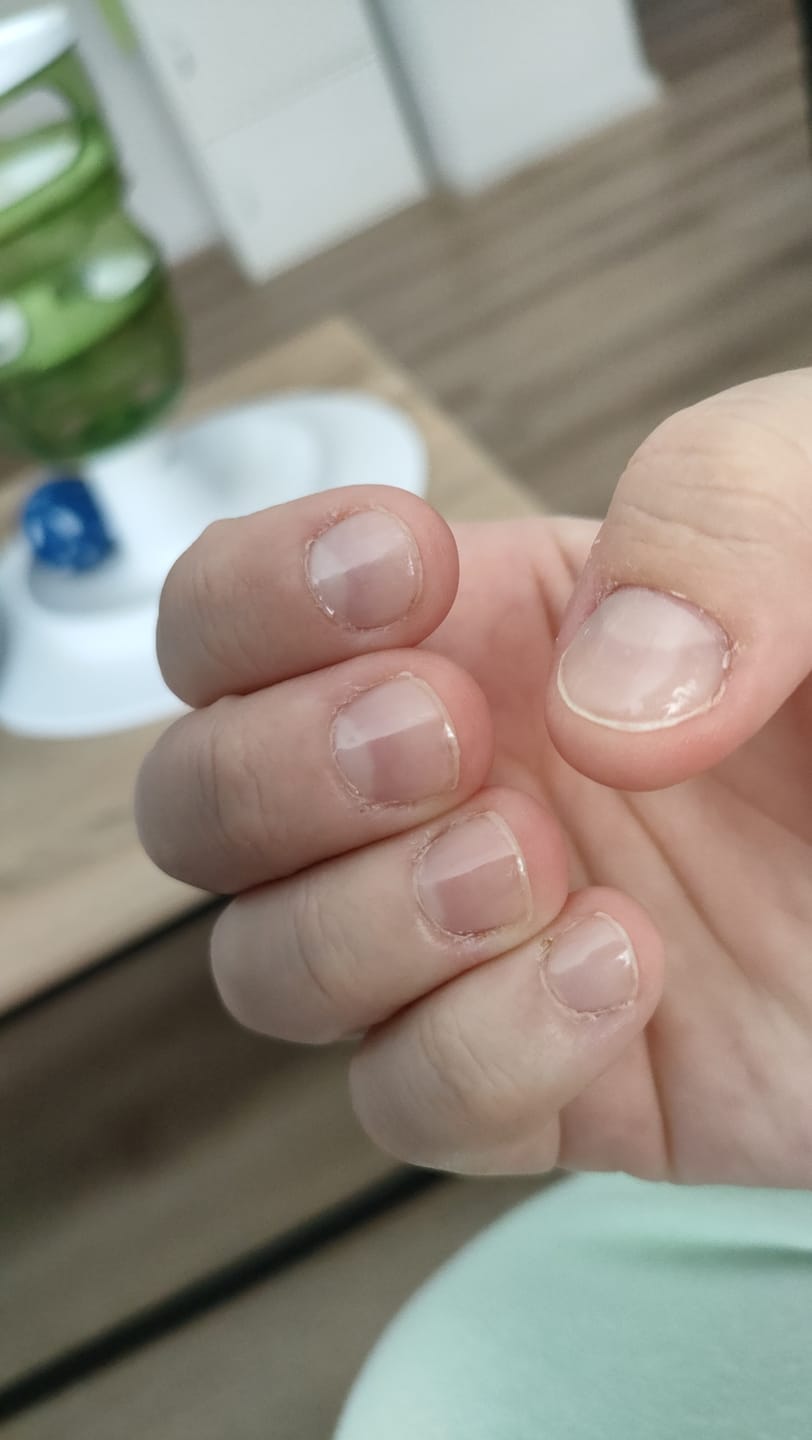 Customer photo review of Crystal Clear DIY Semicured Gel Nail Sticker Kit (STOP NAIL BITING & GROW BRITTLE NAILS)